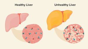 Fatty liver disease and obesity