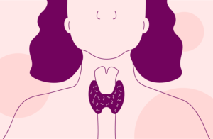 Hypothyroidism in Overweight and Obese Patients