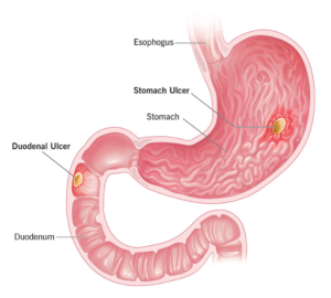 Ulcers after Gastric Bypass